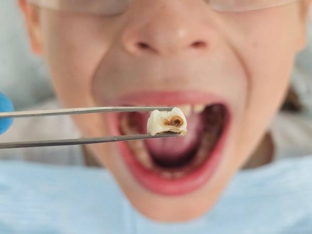 Best Emergency Dental Extractions in Westwood, PA
